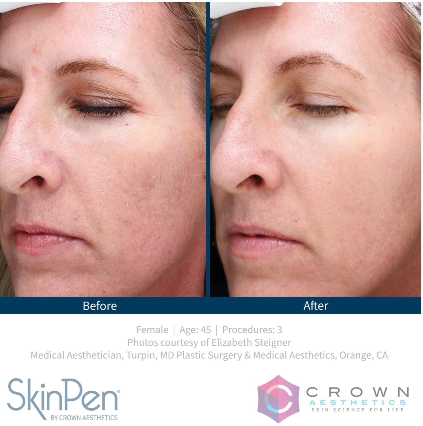 Fine Lines & Wrinkles