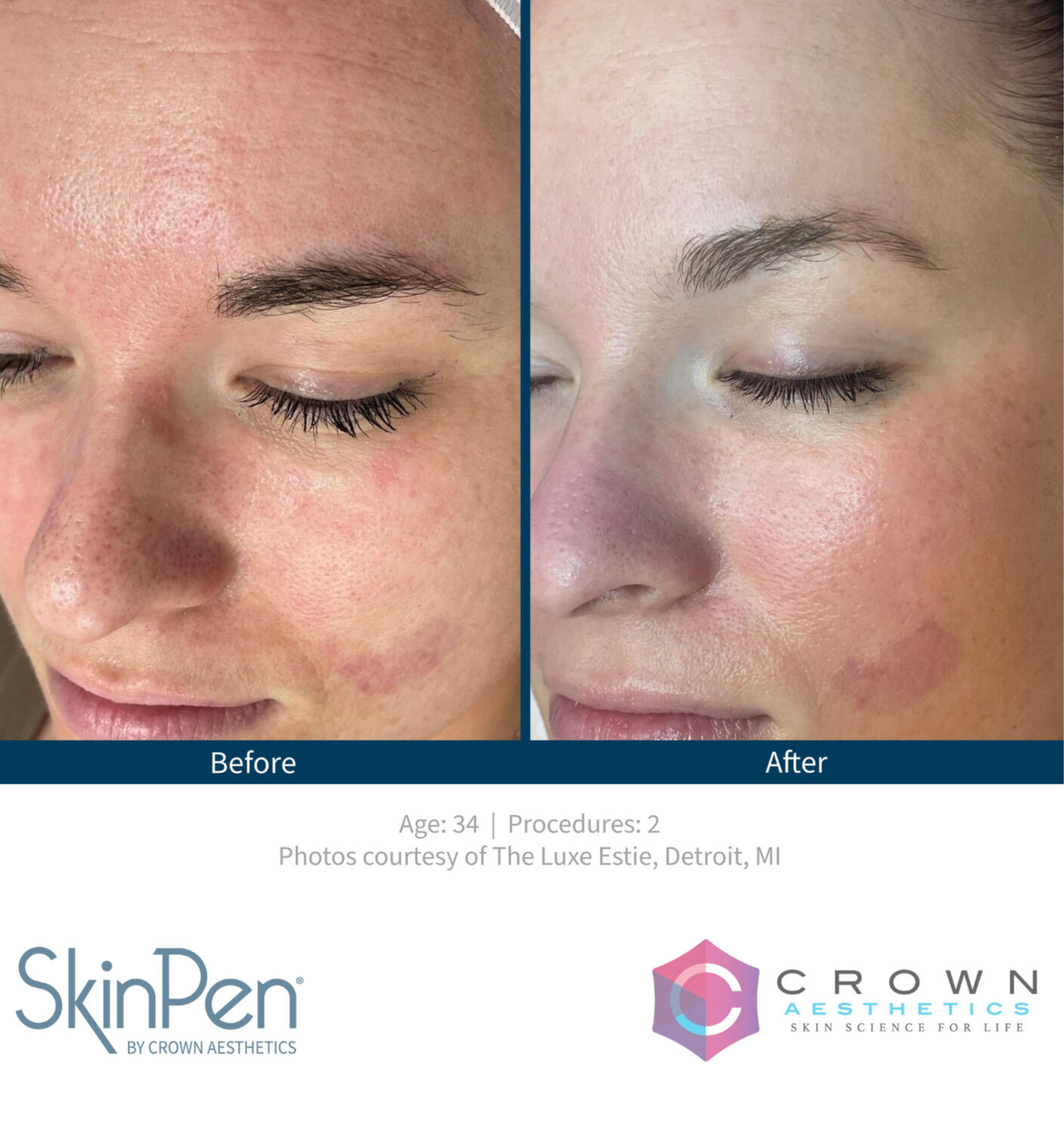 Fine Lines & Wrinkles