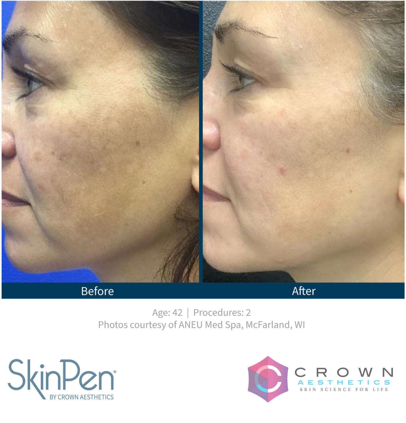 Fine Lines & Wrinkles